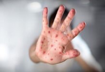 Humanos podem pegar febre aftosa? Entenda como quadro de filha de Tays Reis pode servir de alerta para doenças