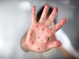 Humanos podem pegar febre aftosa? Entenda como quadro de filha de Tays Reis pode servir de alerta para doenças