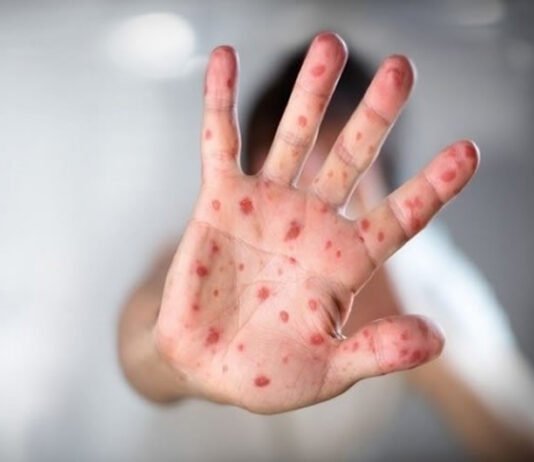 Humanos podem pegar febre aftosa? Entenda como quadro de filha de Tays Reis pode servir de alerta para doenças