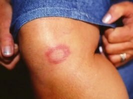 Manchas na pele? Saiba o que cada cor pode significar e quais casos merecem mais atenção
