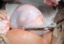 Bebê nasce envolto em bolsa em caso de parto raro em Irecê