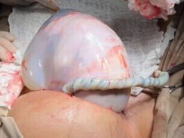 Bebê nasce envolto em bolsa em caso de parto raro em Irecê