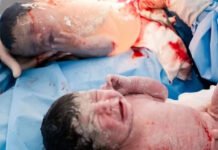 Bahia teve dois partos empelicados de gêmeos no mesmo dia; entenda aqui o fenômeno raro da obstetrícia