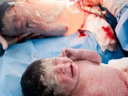 Bahia teve dois partos empelicados de gêmeos no mesmo dia; entenda aqui o fenômeno raro da obstetrícia