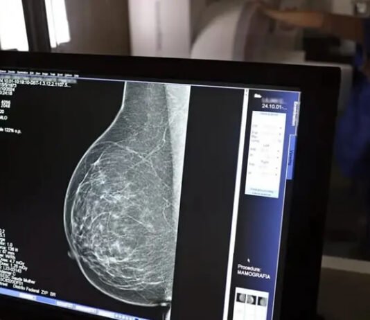 Câncer de mama segue como principal causa de morte por neoplasias entre mulheres na Bahia, diz levantamento