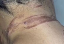 Mulher de 45 anos denuncia que foi enterrada viva pelo ex-namorado após tentativa de feminicídio no sul da Bahia
