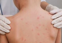 Bahia registra dois casos de meningite em cidade do interior