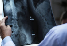 Rápida e sem cortes: como funciona a técnica de médico brasileiro que trata hérnia de disco sem cirurgia; confira