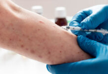 Nova cepa do vírus da Mpox recombinante preocupa OMS e testes mostram que antiviral mais usado não é eficaz