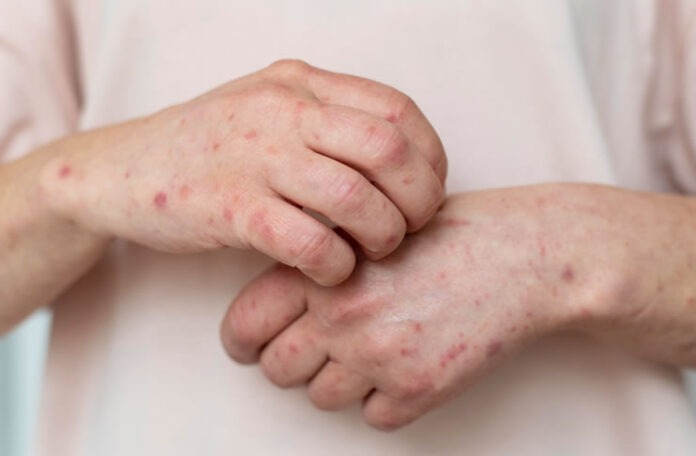 mpox
