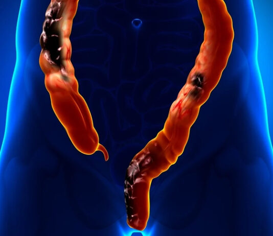 SUS adota novo exame para detectar câncer de intestino antes dos sintomas; Ministério da Saúde anuncia protocolo